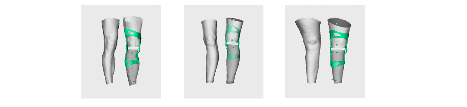 OssKin software to print a knee brace