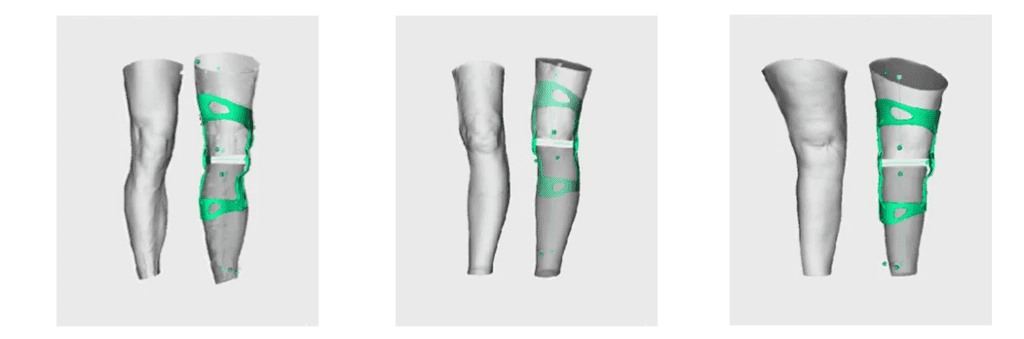 3D knee modelization for a knee brace